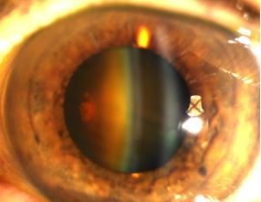 Dense nuclear sclerotic cataract in a 90 year old 